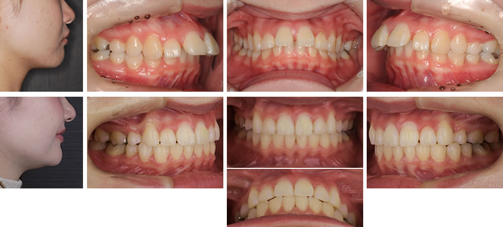上顎前突(出っ歯)の大人の矯正治療例
